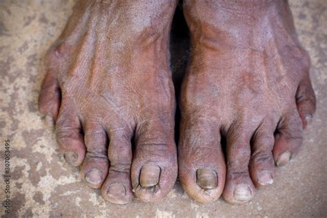 gross feet pictures|Gross Foot Stock Photos and Pictures